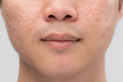 Microneedling for Acne Scars: Reducing acne scars by microneedling