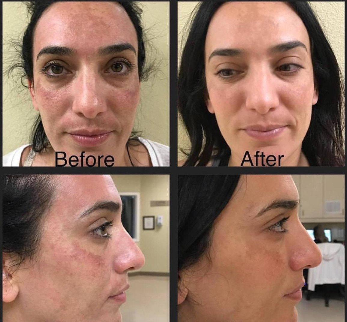 Microneedling before and after – JJ ELLIE SKINCARE Microneedling before and after – JJ ELLIE SKINCARE