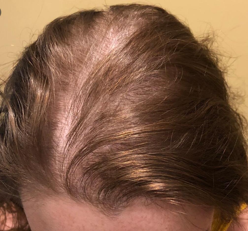 Hairstyles For Women With Receding Hairline · Sustainable Eugene 2020