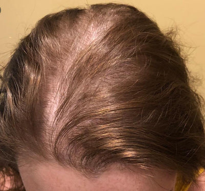 Fighting receding hairline using minoxidil for women